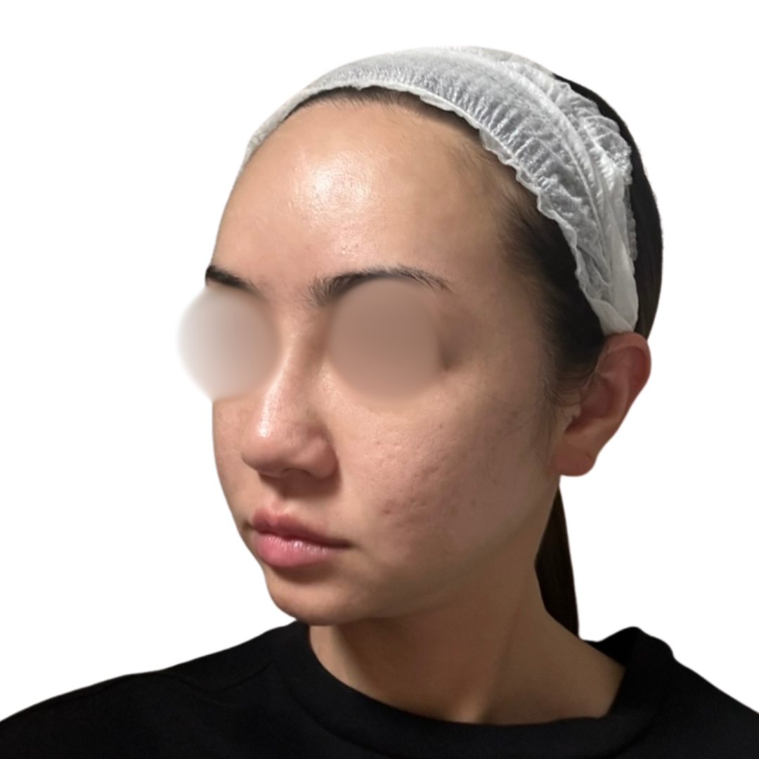 サブシジョン（クレーター治療）